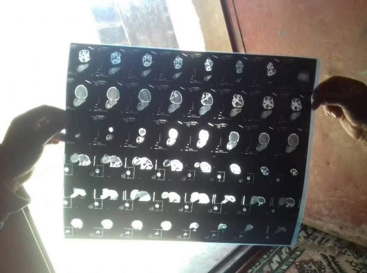 تحتاج إلى عمليات معقدة.. تشوّه خلقي يهدد حياة طفلة حديثة الولادة في الرقة