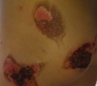 أب سوري يحرق جسد طفله في مخيم القليعات شمال لبنان